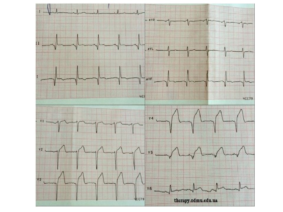 Лечение инфаркта с подъемом st. Подъем сегмента St v5-v6. Подъём St в v5-v6. Конкордантный подъем сегмента St. Подъем сегмента St в в4, 5,6.