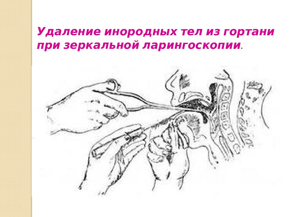 Убрать горловой. Инородное тело гортани ларингоскопия. Извлечение инородного тела из гортани. Рыбная кость застряла в горле. Удаление инородного тела из глотки.