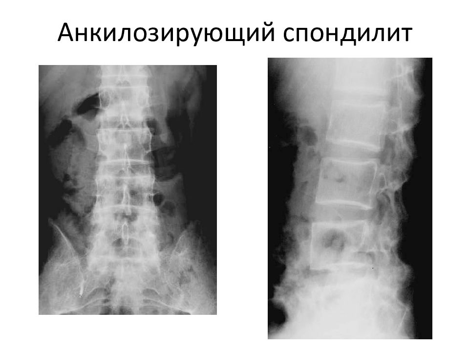 Анкилозирующий спондилит. Анкилозирующий спондилез. Анкилозирующий спондилит фн1. Анкилозирующий спондилит (болезнь Бехтерева) на мрт. Анкилозирующий спондилит периферическая форма.