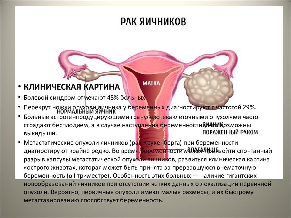 Клиническая картина рака яичников