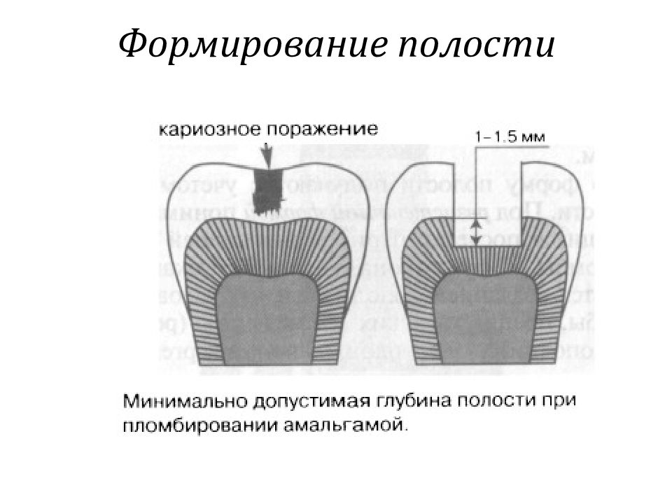 Препарирование кариозных полостей по блэку презентация