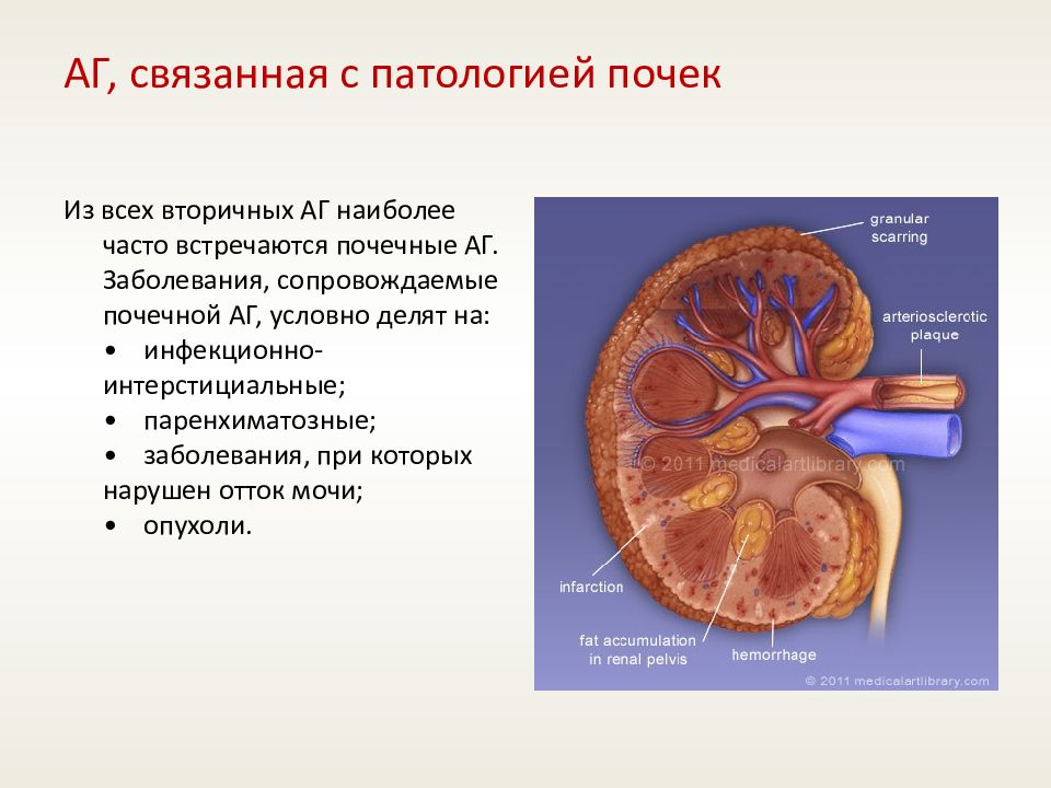 Патология почек. Почечная АГ. АГ при паренхиматозных заболеваниях почек. АГ при патологии почек.