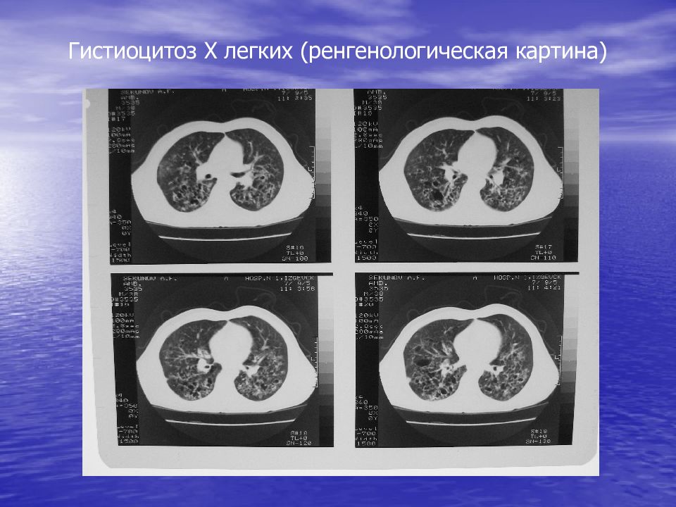 Гистиоцитоз х презентация