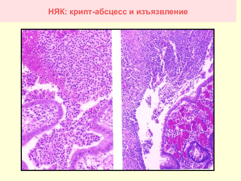 Крипт абсцессы