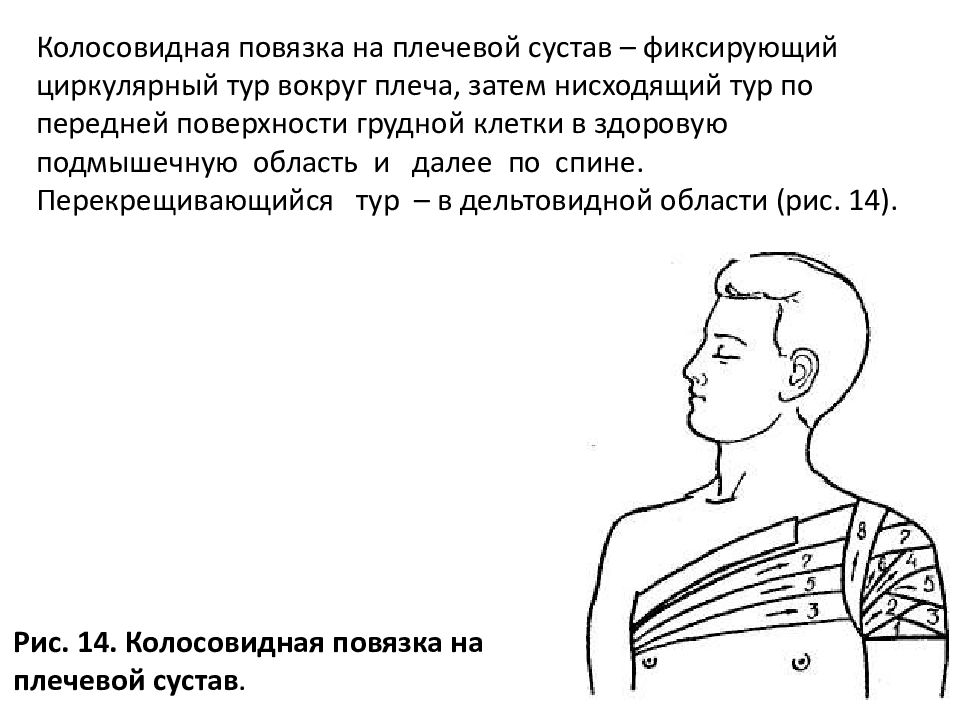 Колосовидная повязка. Техника наложения колосовидной повязки на плечевой сустав. Алгоритм наложения колосовидной повязки на плечо. Наложение колосовидной повязки на плечевой сустав алгоритм. 14. Наложение колосовидной повязки на плечевой сустав..