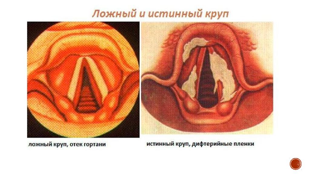 Голосое. Подскладочный ларингит. Подскладочный ларингит (ложный круп). Стенозирующий ларингит («ложный круп»).