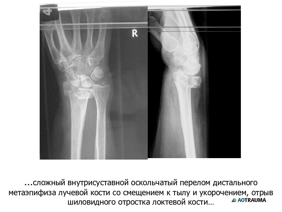 Лучевой кости со смещением. Внутрисуставной перелом дистального метаэпифиза лучевой кости. Многооскольчатый внутрисуставной перелом лучевой кости. Оскольчатый перелом дистальной метаэпифизалучевой кости. Оскольчатый перелом дистального метаэпифиза лучевой кости.