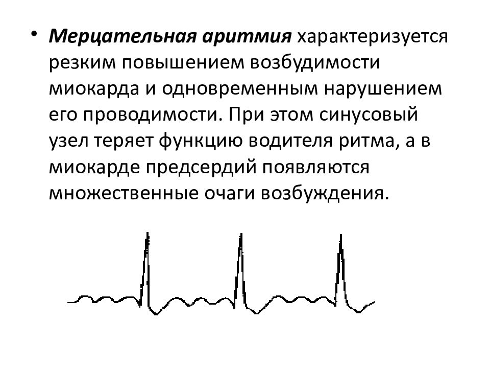 Лечение мерцательной аритмии. Мерцательная аритмия водитель ритма. Мерцательная аритмия характеризуется:. Мерцательная аритмия клиника диагностика. Мерцательная аритмия при митральной недостаточности.