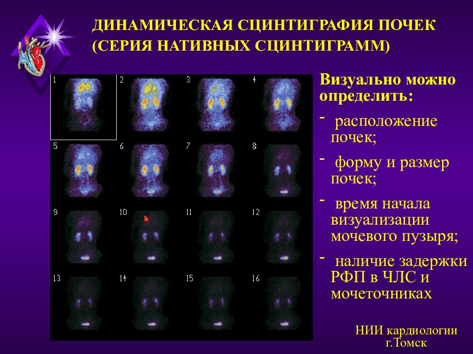 Сцинтиграмма является изображением