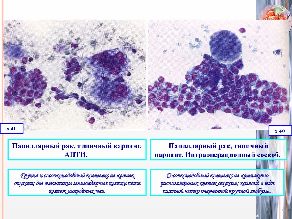 Цитологическая картина папиллярной карциномы щитовидной железы