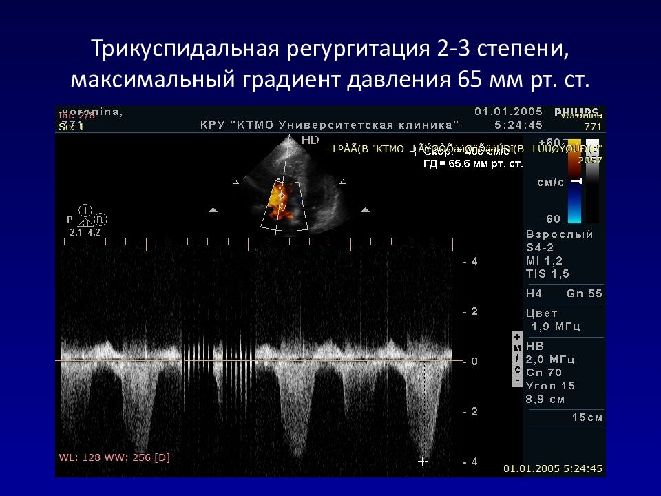 Градиенты на клапанах. Трикуспидальная недостаточность ЭХОКГ. ЭХОКГ 1 степени. Недостаточность трикуспидального клапана ЭХОКГ. Эхокардиография митральная регургитация 1 степени.