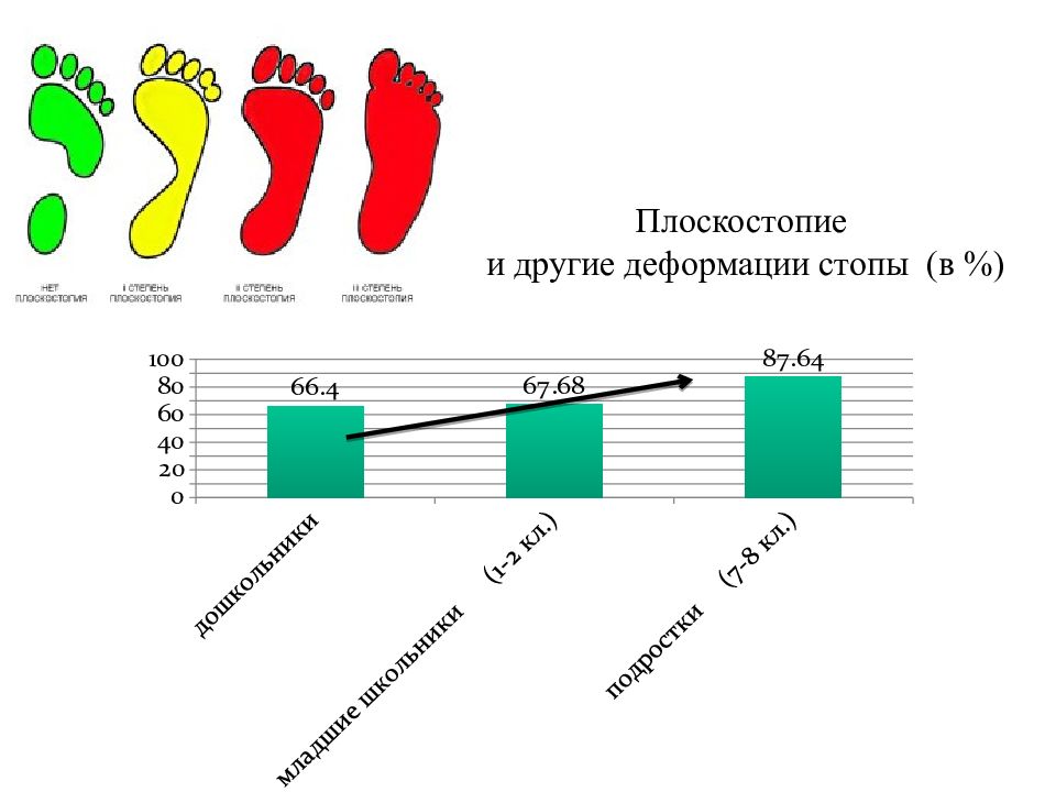 Плоскостопие группа здоровья