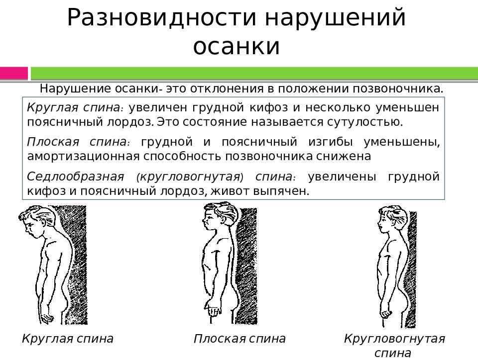 Виды нарушения осанки профилактика нарушений