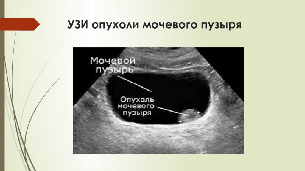 Рак мочевого отзывы