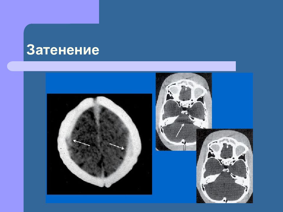 Рентгеновская компьютерная томография презентация