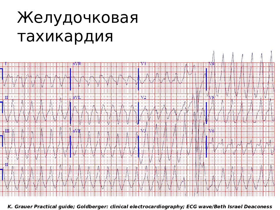 Нарушения на экг