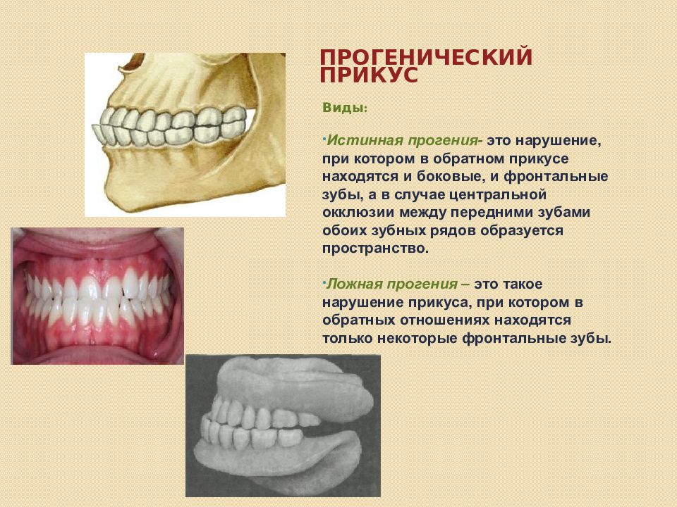 Прогения