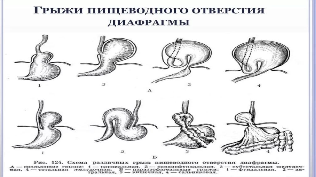 Заболевания диафрагмы презентация