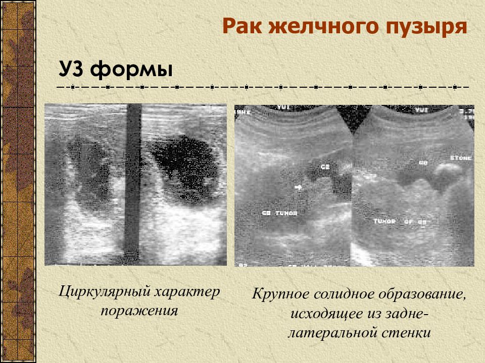 Опухоли желчного пузыря презентация