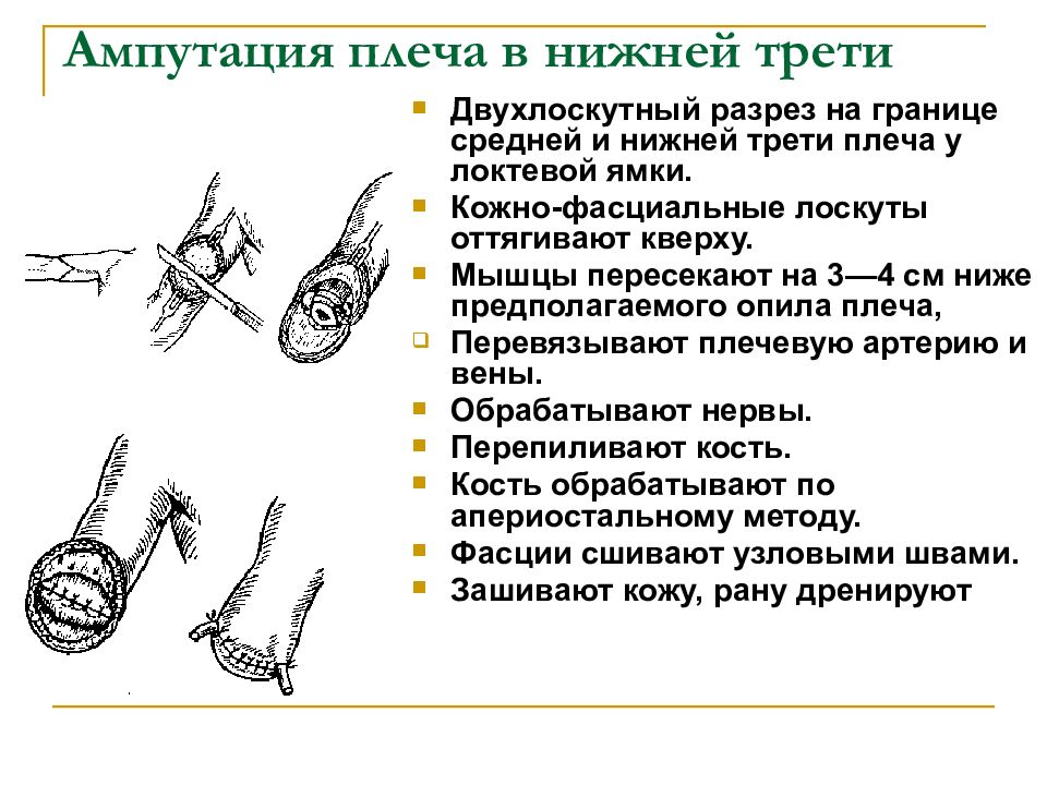 Ампутация предплечья в нижней трети. Реплантация конечностей. Остеотомия лучевой кости. Нижняя треть лучевой кости. Остеотомия локтевого отростка.