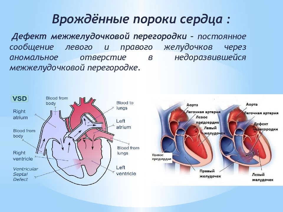 Пороки сердца схема