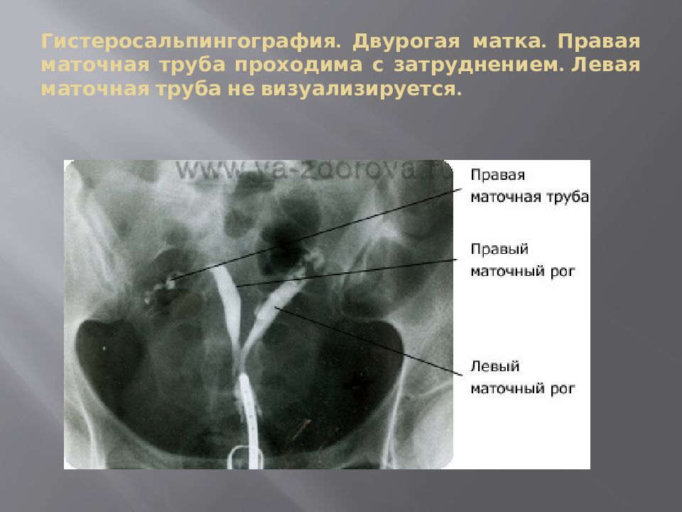 Левая матка. Проходимые маточные трубы. Гистеросальпингография матки.