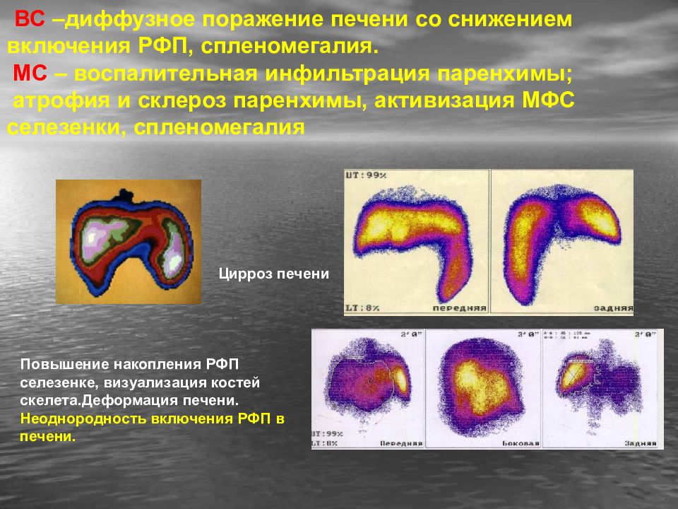 Вторичное поражение. Диффузное накопление РФП. Диффузное наполнение РФП сцинтиграфия. Диффузное повышение накопления РФП.