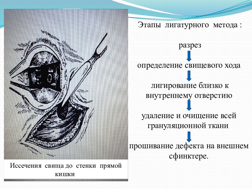 Свищ послеоперационный карта вызова