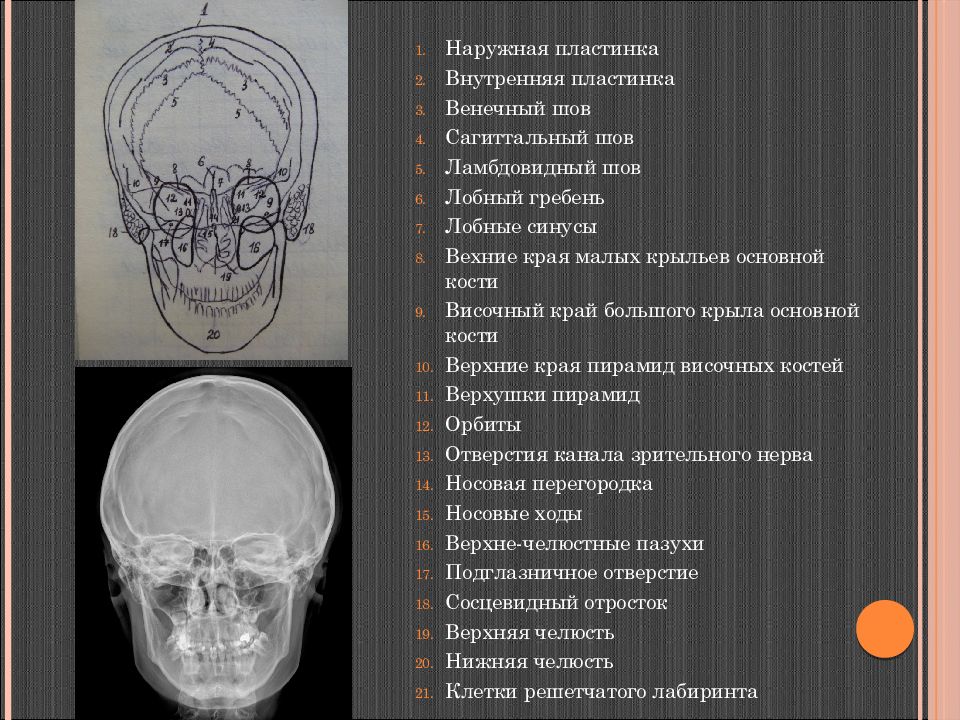 Ламбдовидный шов. Обызвествление сагиттального синуса кт. Обызвествление твердой мозговой оболочки на кт. Обызвествление твердой мозговой оболочки на рентгене.