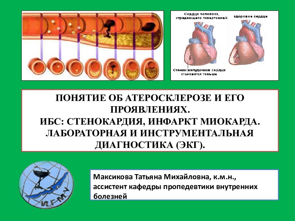 Атеросклероз ибс стенокардия презентация