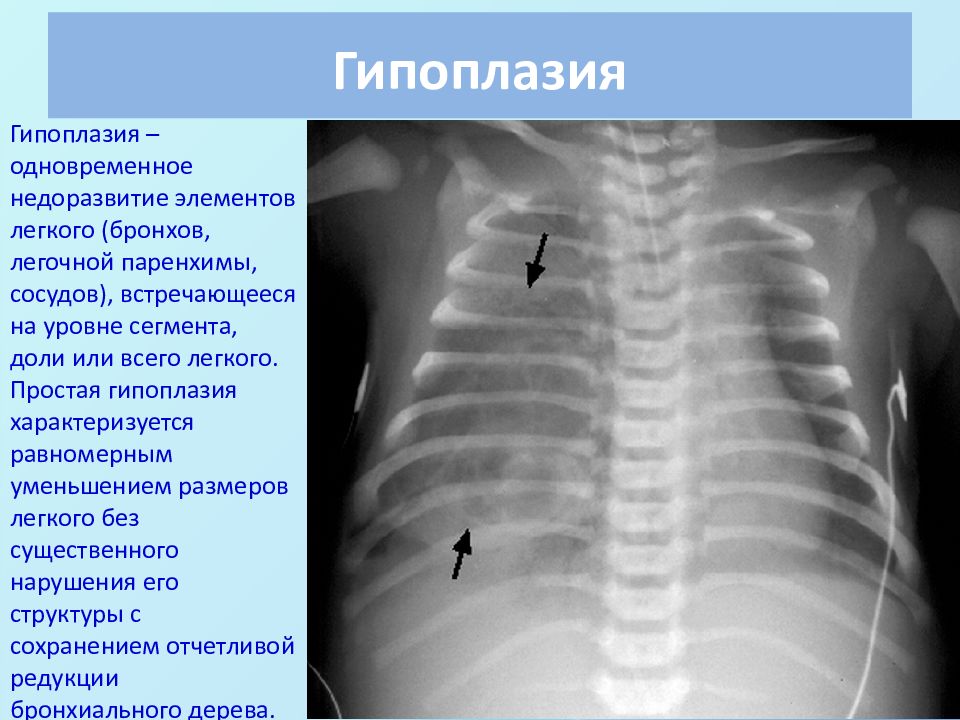 Врожденные пороки развития дыхательной системы презентация