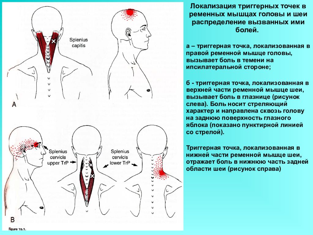 Болит правое плечо отдает в шею. Ременная мышца шеи триггерные точки. Ременная мышца головы триггерные точки. Ременная мышца головы иннервация. Триггерные точки ременных мышц головы и шеи.