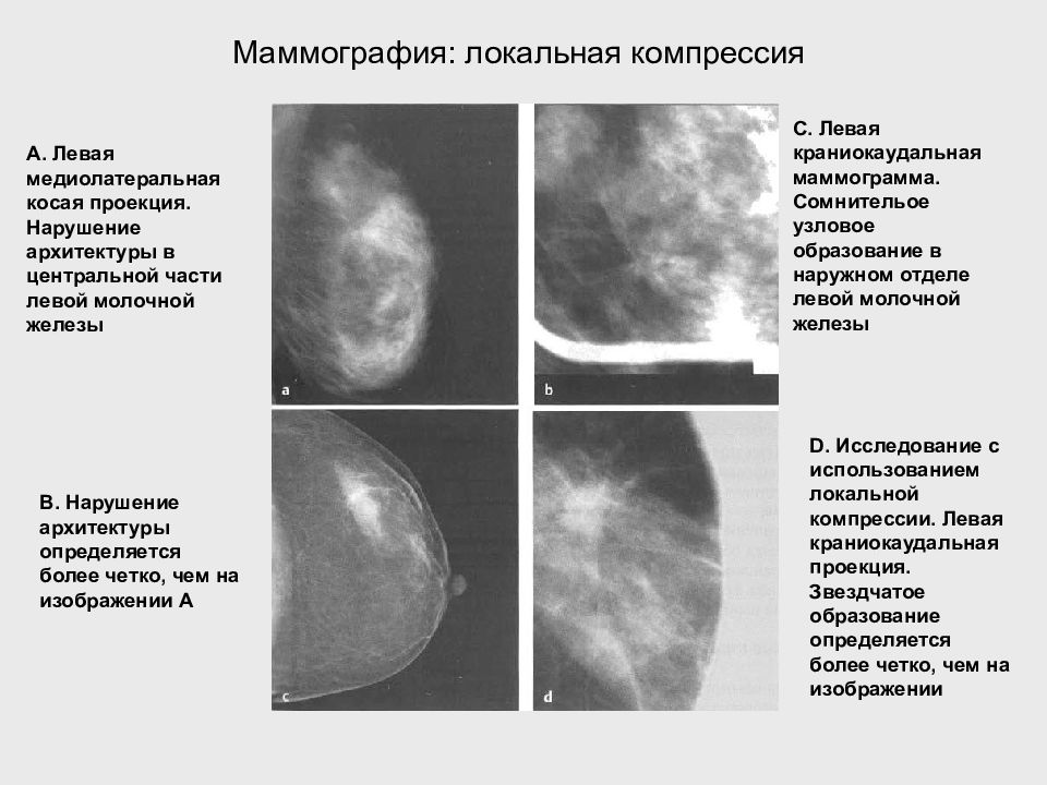 Анализ маммографии. Узловые образования молочной железы на маммографии. Йокогамская классификация молочной железы. Косая проекция маммография. Косая проекция молочной железы.