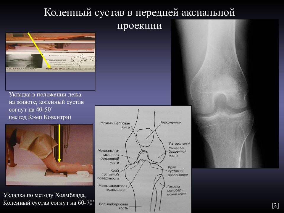 Рентген коленного сустава в двух проекциях фото в норме