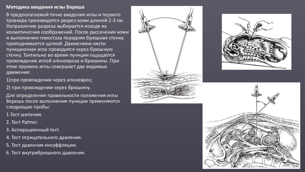 Методика введения. Игла Вереша лапароскопия. Техника введения первого троакара. Осложнения при введении иглы Вереша.