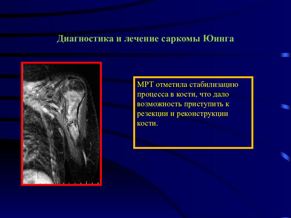 Опухоли костей и мягких тканей презентация