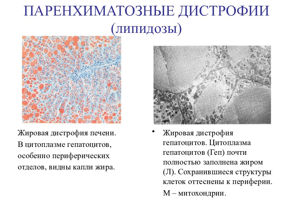 Дегенерация миокарда. Паренхиматозные жировые дистрофии липидозы. Жировая дистрофия миокарда микроскопическая характеристика,. Паренхиматозная дистрофия печени. Паренхиматозная жировая инфильтрация миокарда.