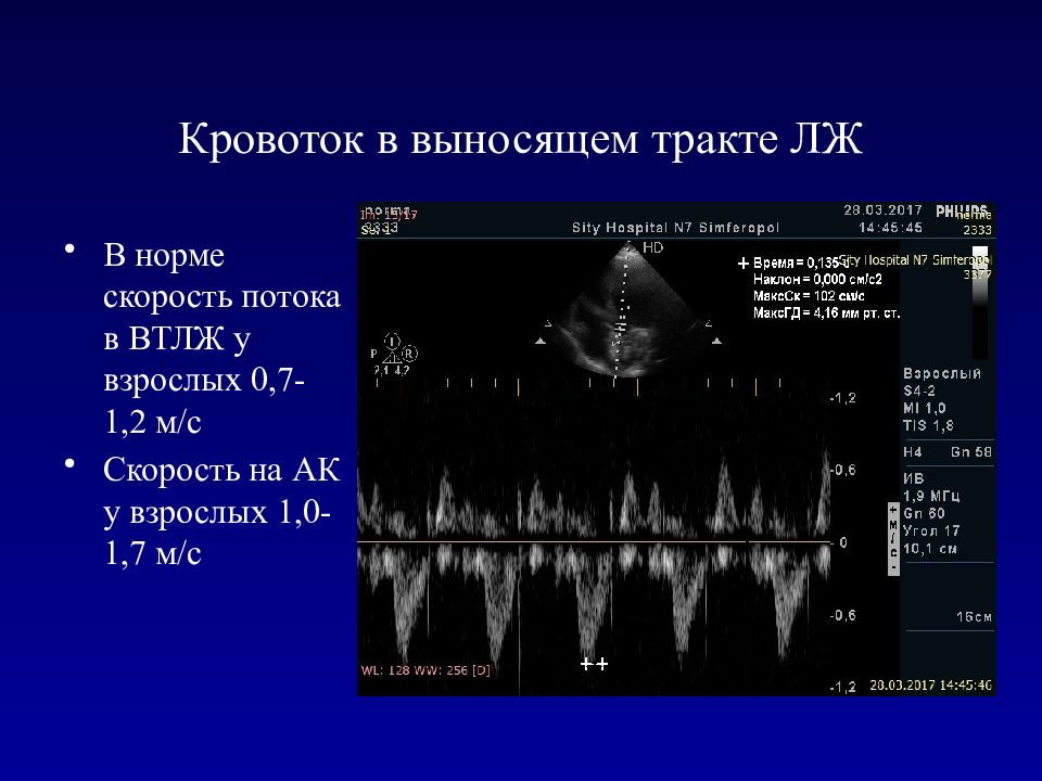 Эхо норма. Диаметр выносящего тракта левого желудочка в норме. Обструкция выносящего тракта левого желудочка ЭХОКГ признаки. Измерение диаметра выносящего тракта левого желудочка. Эхокардиография аортальный клапан скорость.