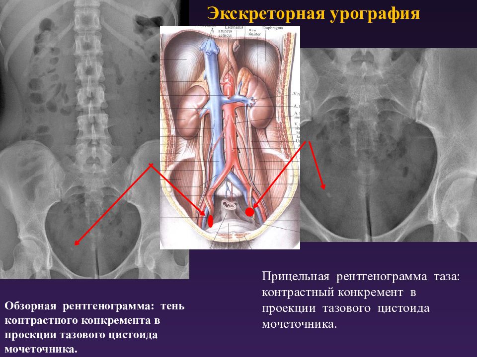 Экскреторная урография