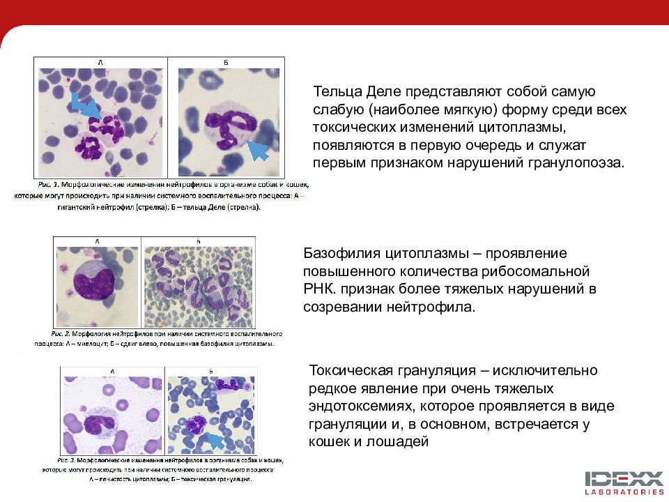 Дегенеративные изменения мазка. Токсигенная зернистость цитоплазмы нейтрофилов. Нейтрофилы морфология и развития. Вакуолизация лейкоцитов. Токсическая зернистость цитоплазмы нейтрофилов.