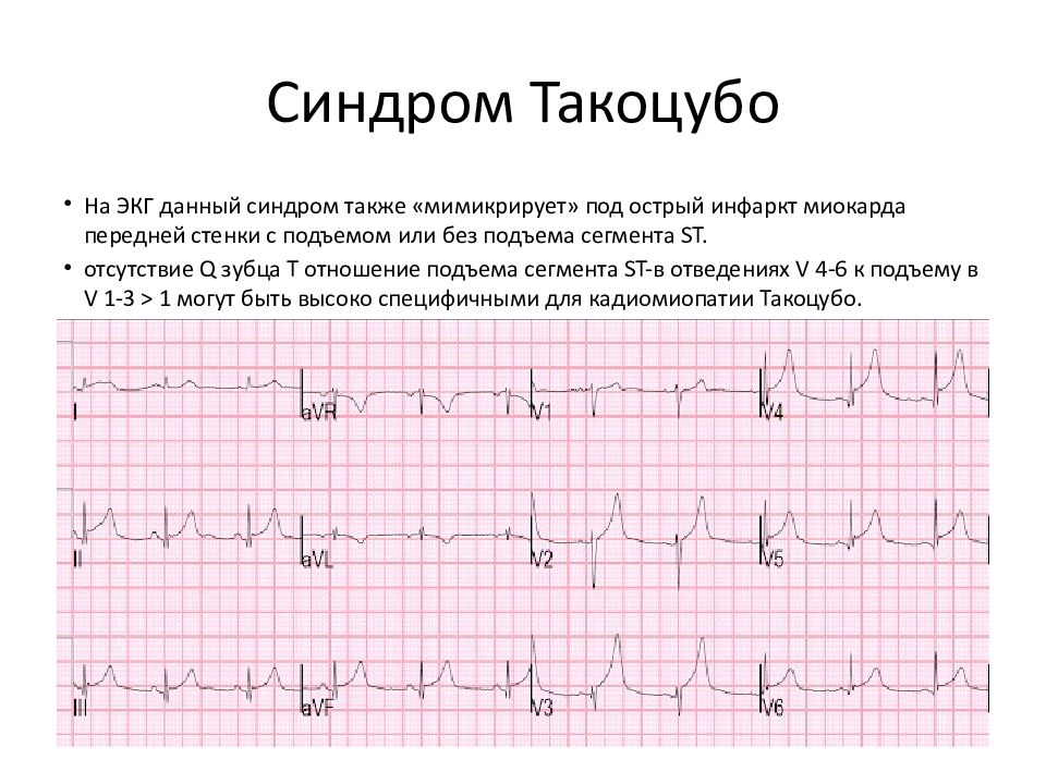 Кардиомиопатия такоцубо презентация