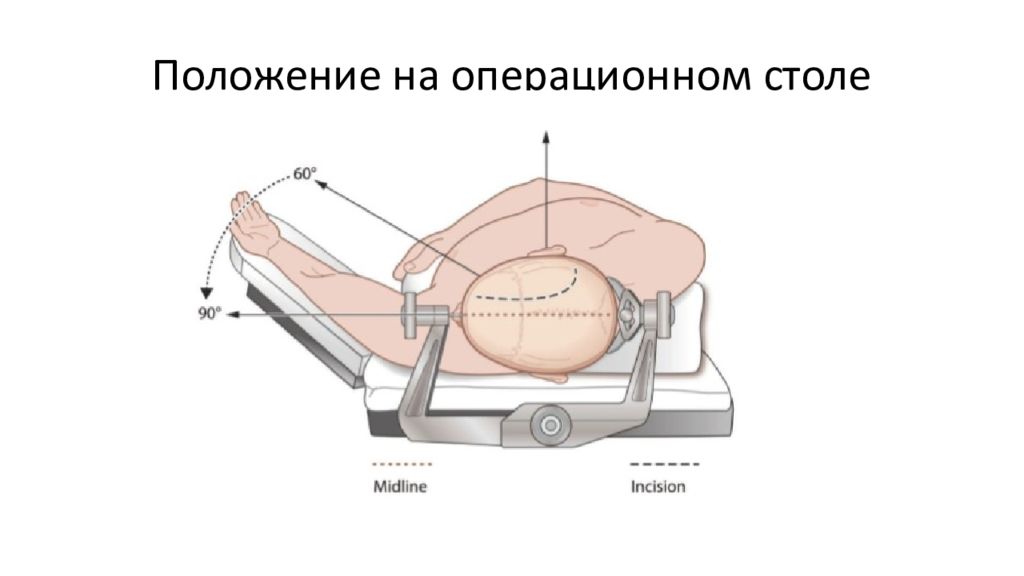 Положение стола. Промежностное положение на операционном столе. Положение пациента на операционном столе. Литотомическое положение на операционном столе. Положение больного на столе.