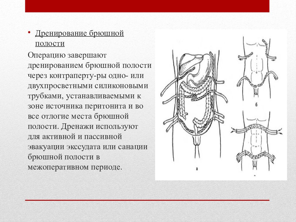 Схема дренирования брюшной полости при перитоните