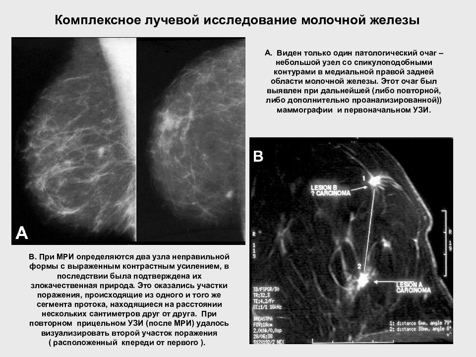 Изменения молочной железы. УЗИ диагностика заболеваний молочных желез. Методы лучевого исследования молочных желез. Методика исследования молочных желез. Рентгенодиагностика заболеваний молочной железы.