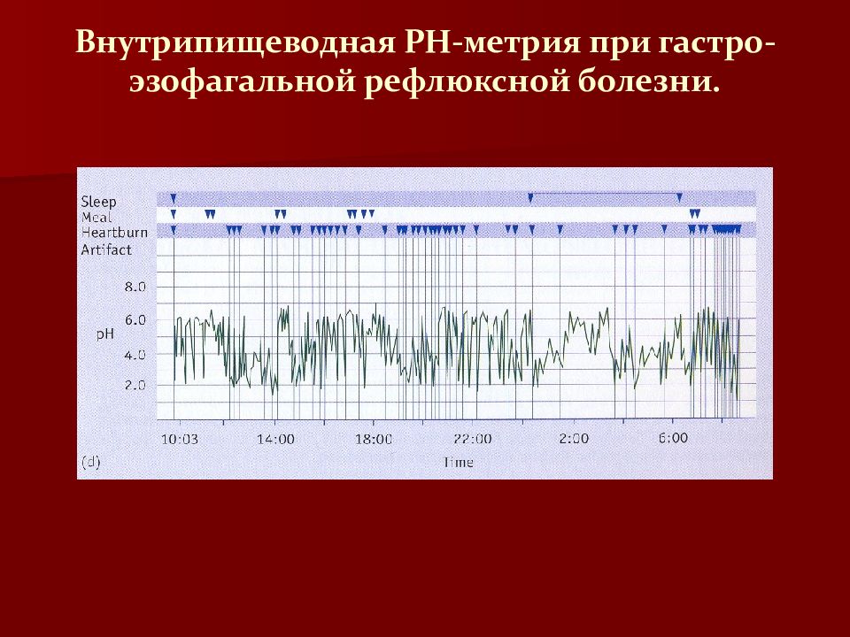 Рн метрия. 24 Часовая PH метрия пищевода. Суточная внутрипищеводная PH-метрия. Суточная РН метрия при ГЭРБ. Показатели PH-метрии.