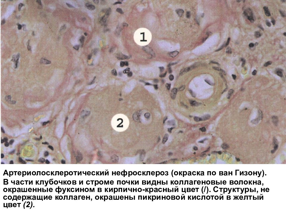 Артериолосклеротический нефросклероз рисунок