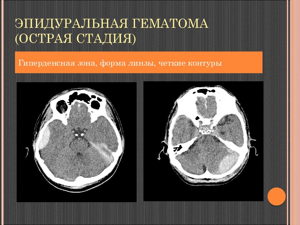 Гиперденсные структуры на кт изображениях