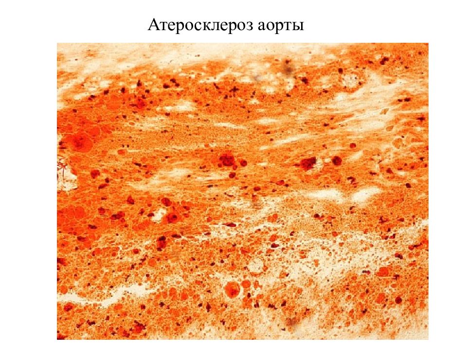 Что такое атеросклероз аорты. Атеросклероз аорты макропрепарат. Амилоидоз сердца макропрепарат. Амилоидоз сердца патанатомия.