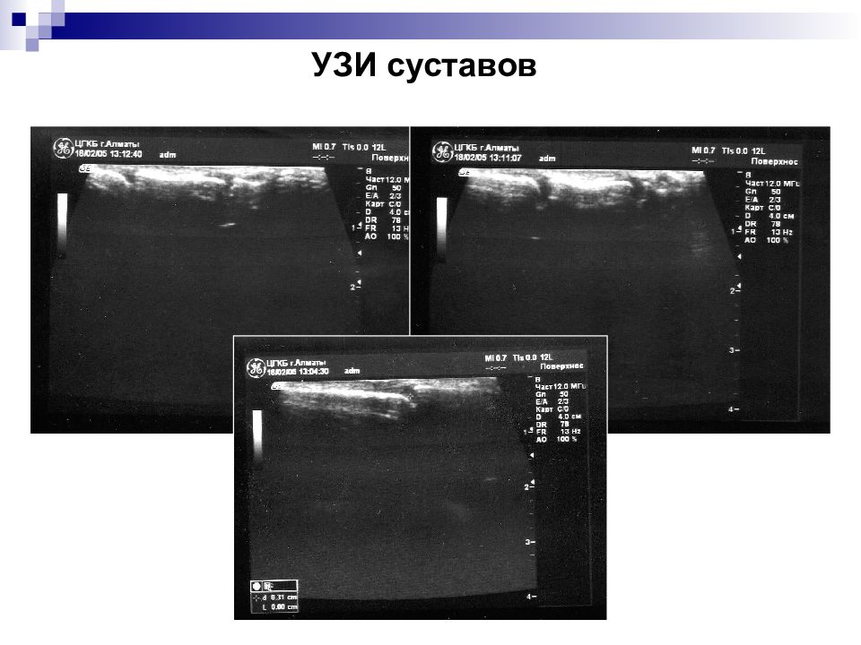 Узи суставов воронеж