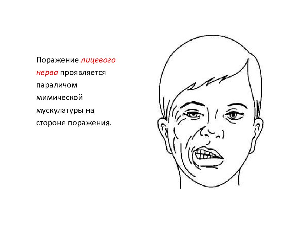 Методы хирургического лечения и восстановительные операции при параличе мимических мышц презентация